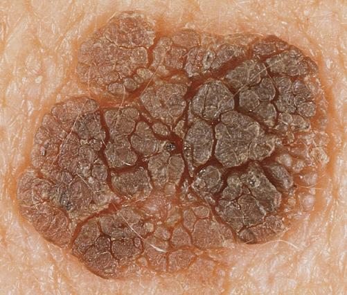 Seborrheic keratosis