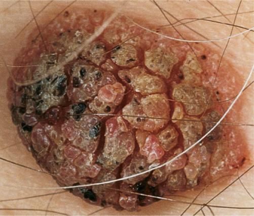 Seborrheic keratosis