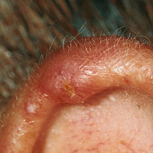 Chondrodermatitis nodularis