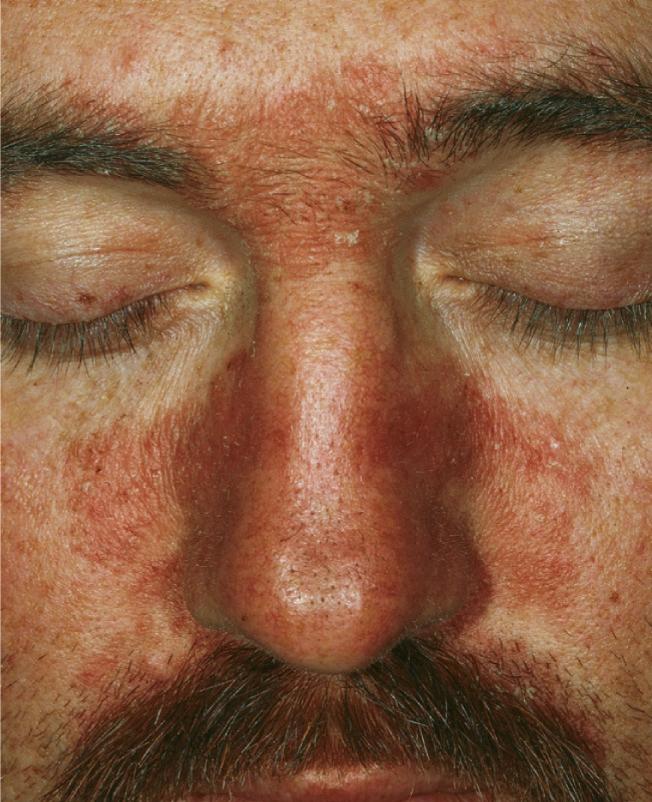 Seborrheic dermatitis