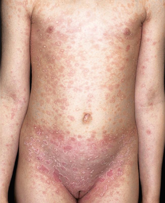 Pityriasis rosea