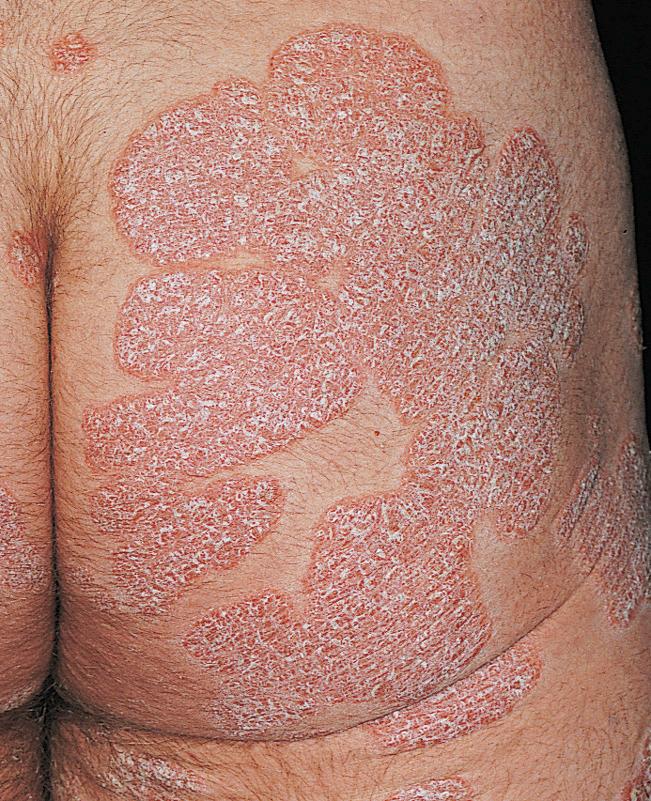 Psoriasis