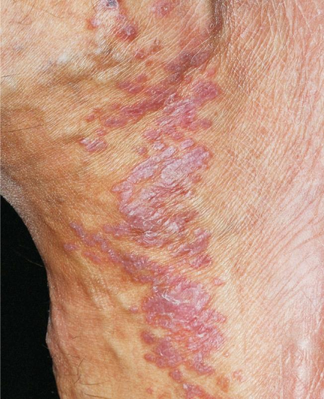 Lichen planus