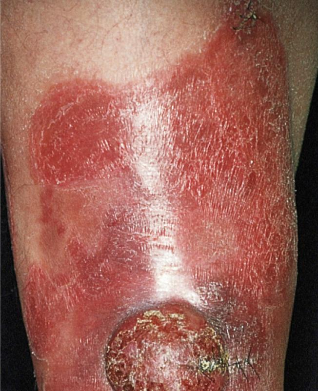 Cutaneous T-cell lymphoma