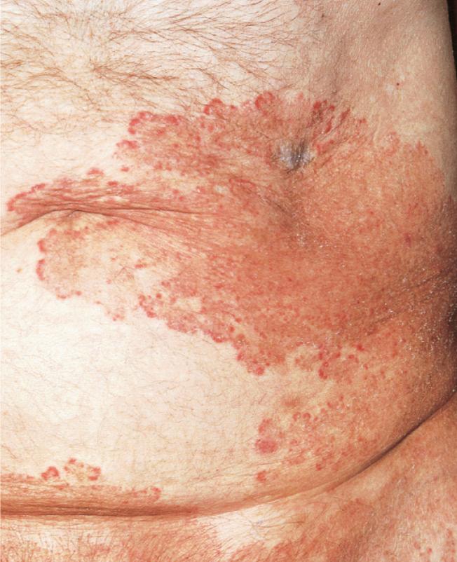 Tinea corporis