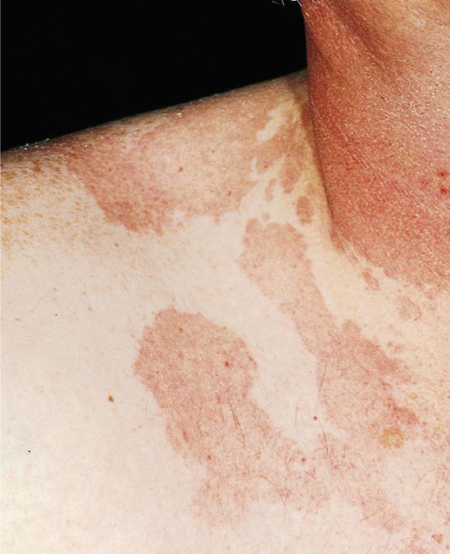 Tinea versicolor