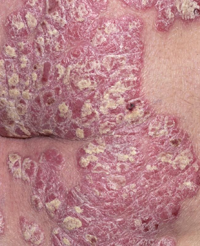 Psoriasis