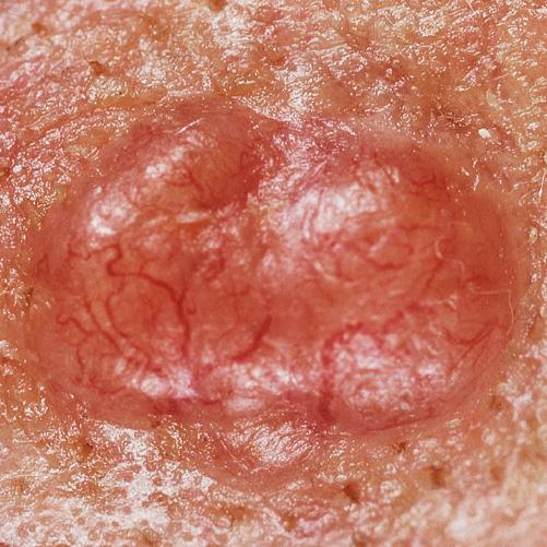 Basal cell carcinoma