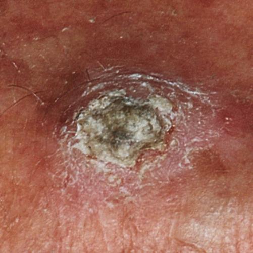 Squamous cell carcinoma