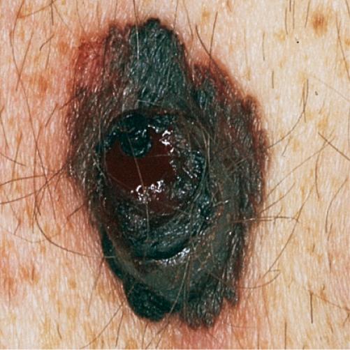 Melanoma