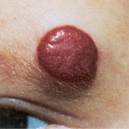 Hemangioma