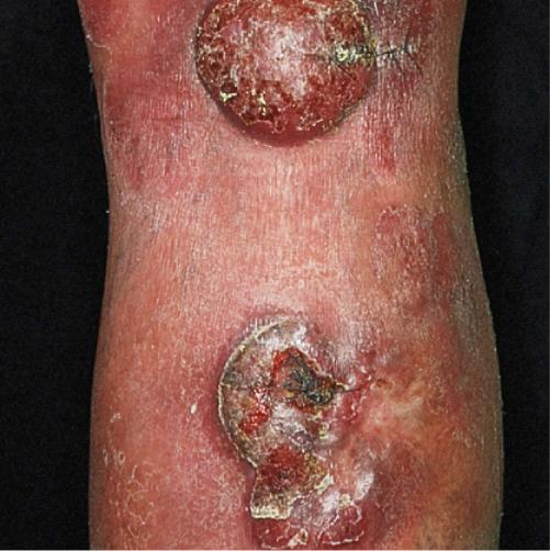 Cutaneous T-cell lymphoma