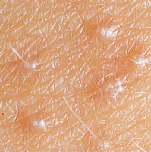 Keratosis pilaris