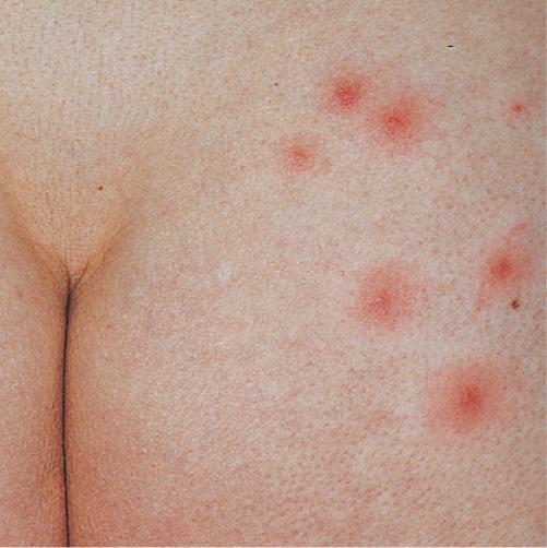 Pseudomonas folliculitis