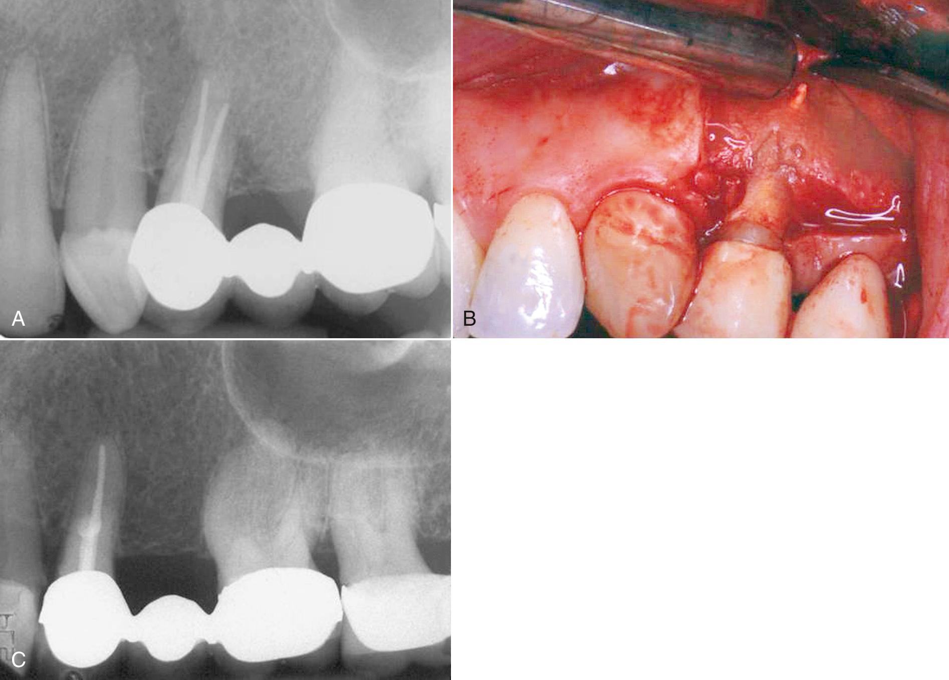 Fig. 18.2, Surgical exploration. (A) The patient had persistent pain over the midroot region following what appears to be successful endodontic treatment. (B) Surgical exploration reveals perforation of the buccal root during the endodontic treatment with displaced gutta-percha. (C) Postoperative periapical film of surgical removal of the extruded gutta-percha and mineral trioxide aggregate seal.