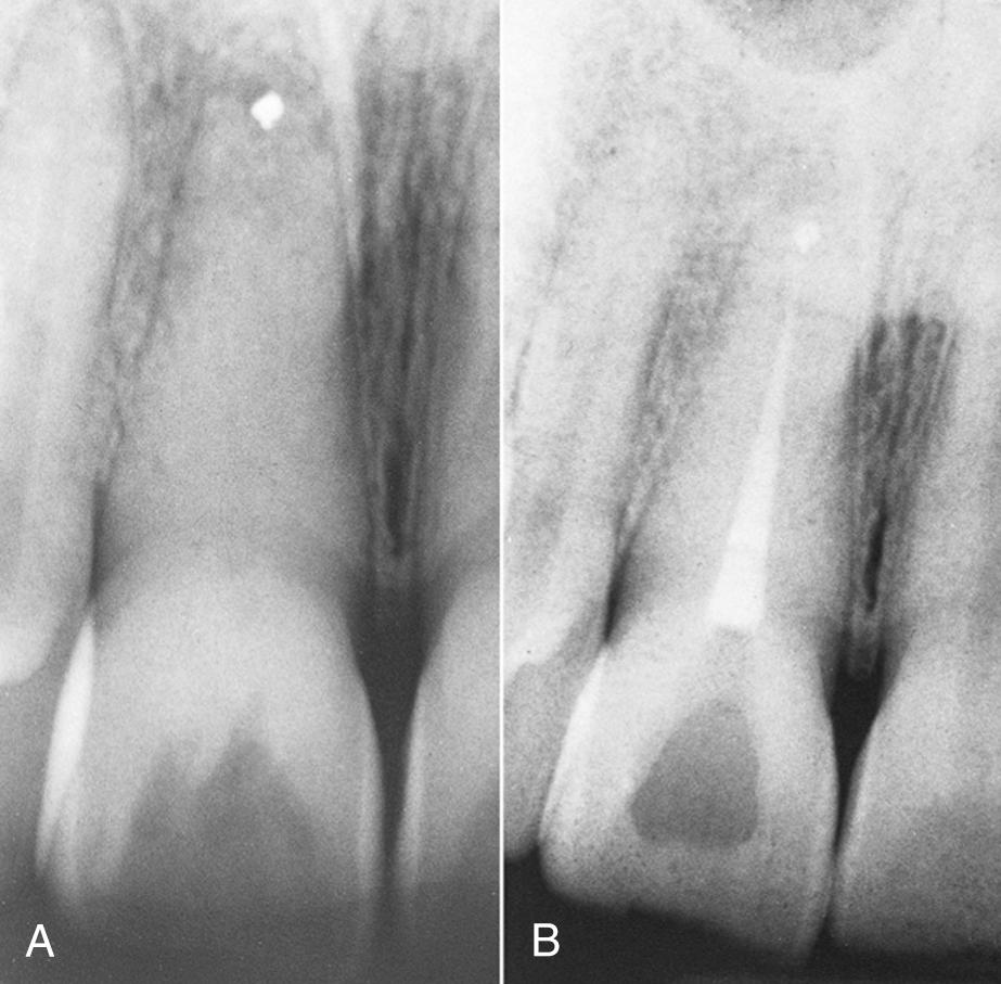 Fig. 18.12, (A) Inadequate root end resection and root end filling have failed to seal the apex. (B) Root canal treatment is readily accomplished, with good chance of success.
