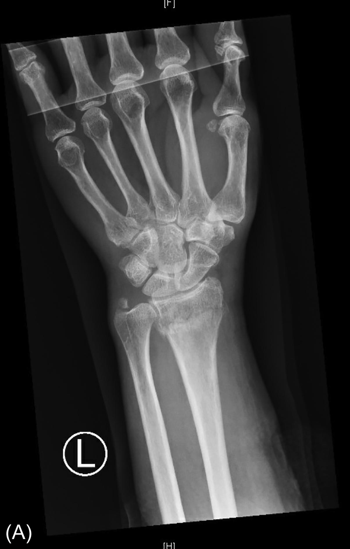 Fig. 1, (A, B) Initial radiographs showing a minimally displaced distal radius fracture. (C, D) Radiographs following initial reduction and immobilization in the emergency department. (E, F) Radiographs at two weeks demonstrating conversion to fiberglass casting material and mild shortening of the fracture with maintained sagital alignment.