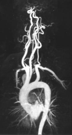 FIG 15.1, Contrast-enhanced magnetic resonance angiography of normal carotid arteries. Sagittal oblique maximum-intensity projection of the thoracic aorta shows normal carotid arteries.