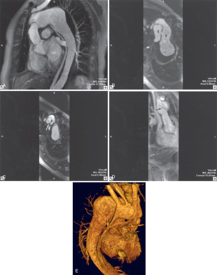 FIG 15.2, Contrast-enhanced magnetic resonance angiography (MRA) of aortic dissection. (A) Sagittal multiplanar reformatting (MPR) in a patient after repair of a type A aortic dissection with valved homograft in the ascending aorta. There is dilatation of the transverse arch. The residual intimal flap is seen as a dark stripe in the descending thoracic aorta. (B) Axial MPR at the level of the transverse aorta shows the intimal flap with a communication between the large false lumen (f) and the true lumen (t). (C) Axial MPR at a higher level shows the intimal flap involving the innominate and left common carotid arteries (arrow). (D) Coronal MPR shows that the intimal flap starts just above the homograft (arrow). (E) Three-dimensional volume-rendered MRA of the thoracic aorta shows the compressed true lumen and the dilated false lumen.