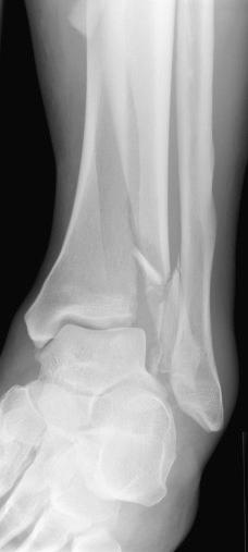 Fig. 9.13, Simple-pattern diaphyseal extension of a segment of the articular surface of the tibial plafond. Without an anatomic reduction of the diaphyseal extension, the articular surface cannot be placed back into appropriate position with respect to the articular surface of the fibula (which is not fractured) and the Chaput or anterolateral segment of the tibia.