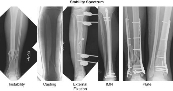 Fig. 9.15, Spectrum of stability is noted with constructs used in tibia fracture treatment. Instability is noted at the far left with a complex tibial fracture with no support. With loading, this fracture would displace and not return to its original position. Relative stability is noted in the middle images with casting, external fixation, intramedullary rodding, and bridge plating. With loading, these constructs should produce micromotion to induce callus formation for secondary healing. Absolute stability is noted with neutralization plating and independent lag screws on the far right. With loading, no motion should occur. This construct relies on primary bone healing as no induction of callus formation through motion can occur. IMN, Intramedullary nail.