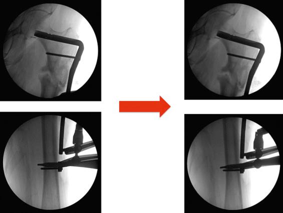 Fig. 9.17, Intraoperative radiographs with attempted axial compression of an oblique fracture pattern with the articulated tensioning device. Because the compression was not perpendicular to the fracture line itself, shear was created. Shear medially translated the distal fragment along the obliquity of the fracture line. Look closely at the position of the most medial callus on the “before” and “after” images.