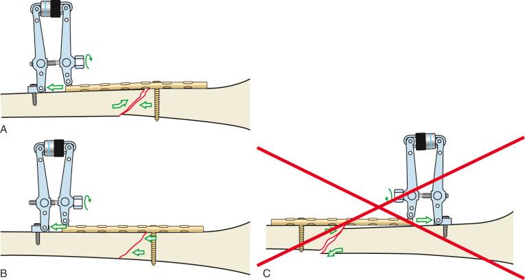 Fig. 9.18, Examples of compression tools and devices. (A–C) Articulated tensioning device (ATD). In (A) and (B), the plate is first attached to the obtuse-angled fragment and then compressed to the other fragment with the use of the ATD. Note the same concept previously covered in Fig. 9.17 . In (C) compression along an obliquity can be detrimental to reduction if the axilla created by the plate and bone is not in the position to capture the spike of the other fragment. In this example, the plate should have been attached to the other fragment first, such that compression into the axilla could occur. (D–E) Universal distractor (UD). This device consists of a spindle rod, a carriage, and nuts that allow for either compression or distraction through attachment to Schanz pins on each side of the fracture. (D) Using the UD in distraction at the fracture site allows the fracture ends to be aligned. (E) Compression across the fracture through reversing the force created by the universal distractor into compression (i.e., moving the other nut against the carriage, which is connected to the Schanz pin). The fracture can then be plated while it is being compressed. (F and G) Push–pull concept using the lamina spreader and a Verbrugge clamp. The plate is attached to one side of the fracture. A lamina spreader is used to distract across the fracture site via an independent screw placed outside of the plate. Once realignment of the bone ends has occurred with Weber clamp guidance, the lamina spreader is traded for a Verbrugge clamp, which then compresses the fracture using the same independent screw.