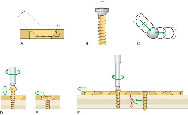 Fig. 9.19, Screw hole design on the dynamic compression plate. The modified screw hole known as the dynamic compression unit (DCU) allowed for eccentric placement of a screw into a plate to create a compressive effect without requiring an external device. This concept is based on a carpenter's principle but was technically improved to limit parasitized forces. The path for the screw must be drilled eccentrically within the plate's screw hole (adjacent to the inclined side of the screw hold) for this principle to work. (A) The screw hole is oblong in shape and resembles an inclined cylinder at one end connected with a horizontal cylinder. Here an inclined cylinder joined with a horizontal cylinder is superimposed on the screw hole to illustrate this. (B) The screw head is rounded on its undersurface and can be conceptualized as a ball. (C) When advancing the screw, the head of the screw eventually makes contact with the edge of the plate hole. This is analogous to a ball being placed in the inclined cylinder. (D–F) With further tightening of the screw (i.e., further rolling of the ball down the inclined cylinder), the screw displaces the plate (and with it, the other fracture fragment already attached to the plate) as it centers itself, causing compression at the fracture site.