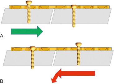 Fig. 9.20, Oblique fracture patterns subjected to compression with plate application. (A) Attaching the plate to the side that creates an obtuse angle creates an axilla such that compression prevents shear by trapping the fragment. (B) Attaching the plate to the side that creates an acute angle fails to create an axilla such that compression leads to shear along the surface of the obliquity. This is the reason that both the fracture orientation and the surface of bone that normally accepts a plate are important in defining the mechanics of your fixation device.