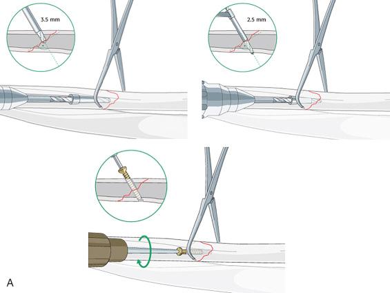 Fig. 9.21, Lag screw placement by technique. (A) The fracture is anatomically reduced and held in compression via a pointed reduction clamp. A small fragment lag screw is then placed by technique. The glide hole (which is approximately the size of the outer diameter of the screw) is first drilled. The drill guide is then inserted into the glide hole. The far cortex hole (which is approximately the size of the inner diameter of the screw) is then drilled. (B) Lag screw placement by design. The screw is partially threaded. Only the screw threads contact the bone in the drilled hole, thereby creating the same effect as though a glide hole had been drilled.