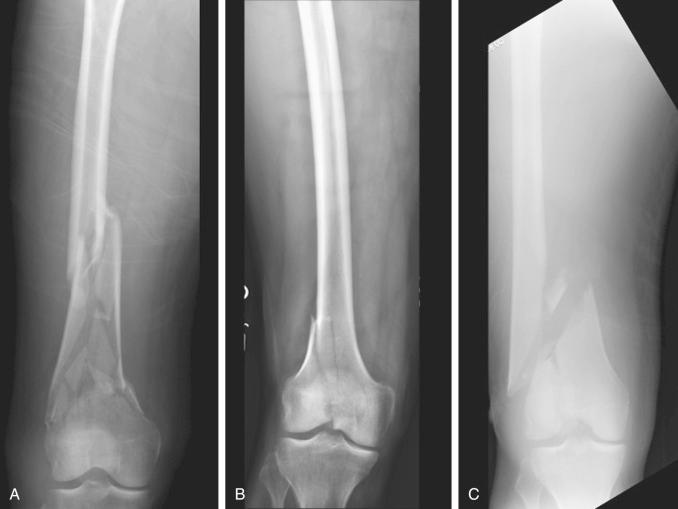 Fig. 9.22, Fracture pattern affects strain. This must be considered when creating a fixation montage. The type of stability that will be present should be decided at the beginning in the preoperative plan and is based partly on the fracture pattern as noted. (A) Complex metaphyseal fracture pattern noted in a supracondylar femur fracture. (B) Simple articular split noted in medial femoral condyle fracture. (C) Simple metaphyseal pattern in supracondylar femur fracture.