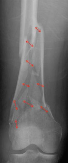 Fig. 9.23, A comminuted, multifragmentary distal femur fracture. The multiple red arrowed lines represent all the individual distances between each of the fragments. Because there are so many distances, the sum of all these distances yields a relatively large denominator in the strain equation, leading to a low overall strain.