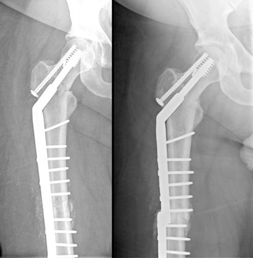 Fig. 9.24, Stress concentration is noted between the two screws that were placed very close to the fracture on each side of the construct. Failure occurs in this location.