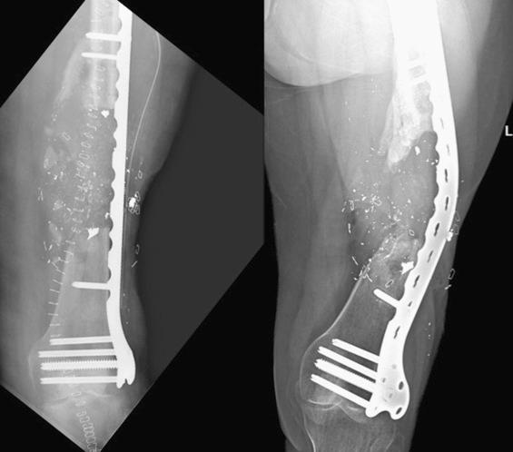 Fig. 9.25, Stress distribution is noted over the large segment of bone loss that was grafted. Note the bowing of the plate over the distributed area of stress.