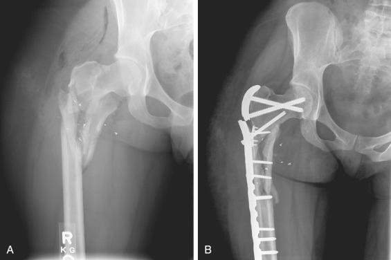 Fig. 9.4, (A) Anterior-posterior (AP) injury radiograph of subtrochanteric fracture with varus coronal plane displacement. (B) AP failure radiograph once again revealing varus displacement. If you want to know what your failure films will most likely look like, take the injury films and draw in broken hardware or intact hardware with implant–bone junction failure.