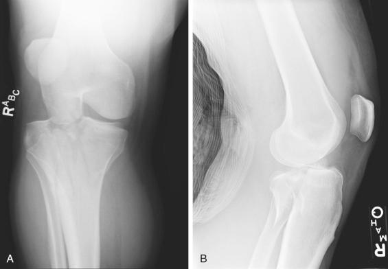 Fig. 9.5, Anteroposterior (A) and lateral (B) views of a bicondylar tibial plateau fracture in which the medial-sided injury consists of a posteromedial fragment. Anterior translation of the tibial shaft (which is connected to the anteromedial fragment) is noted on the lateral radiograph. Primary and secondary stabilizers of the shaft against anterior translation are absent secondary to tibial eminence injuries and a dysfunctional posteromedial corner injury.