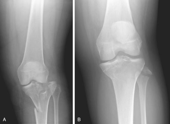 Fig. 9.6, Medial plateau fractures with varying injury patterns, which indicate different soft tissue injuries. (A) Medial tibial plateau fracture-dislocation revealing lateral condylar widening, centrolateral articular impaction, and shortening. (B) Medial plateau fracture revealing medial articular impaction and varus hinge instability with avulsion of the lateral capsule, lateral collateral ligament, and biceps femoris.