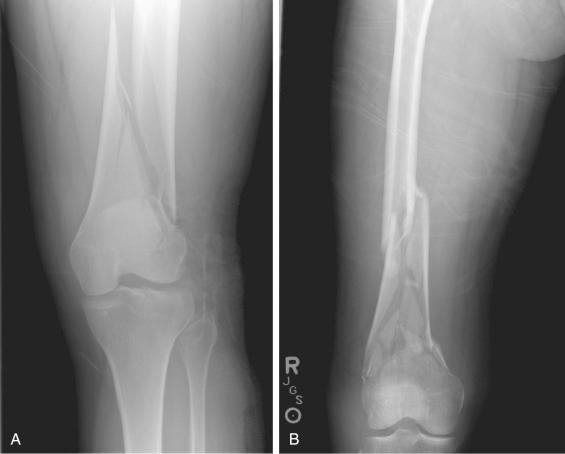 Fig. 9.7, Supracondylar femur fractures with varying metaphyseal fracture patterns. (A) Simple metaphyseal fracture pattern. (B) Complex metaphyseal fracture pattern.