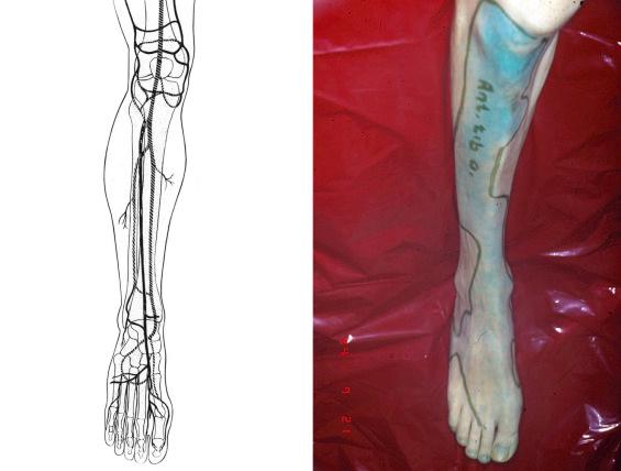 Fig. 9.8, Angiosome of the anterior tibial artery. The diagram reveals the typical vascular anatomy of the lower limb. The picture reveals the vascular territory that is supplied by the anterior tibial artery.