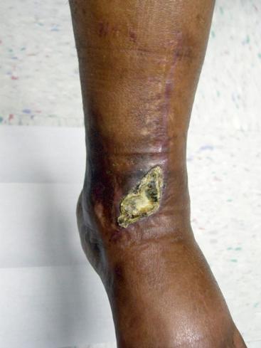 Fig. 9.10, Tibial pilon fracture wound-healing complication associated with anteromedial approach. Note that the location of the healing problem is in the junctional area that is provided blood supply by the anterior tibial artery.