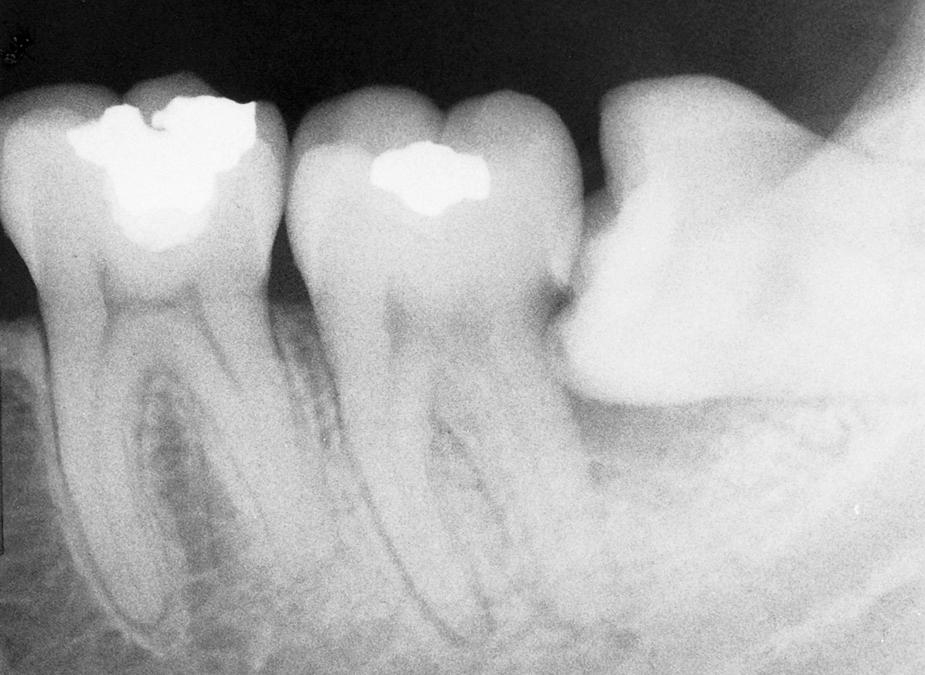 Fig. 10.1, Radiograph of a mandibular third molar impacted against a second molar with bone loss resulting from the presence of a third molar.