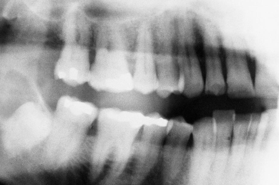 Fig. 10.11, Small dentigerous cyst arising around an impacted tooth.