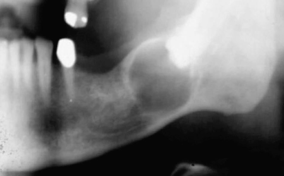 Fig. 10.13, Ameloblastoma associated with the crown of an impacted third molar.