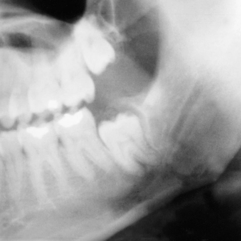 Fig. 10.14, Fracture of a mandible, which occurred through the location of an impacted third molar.
