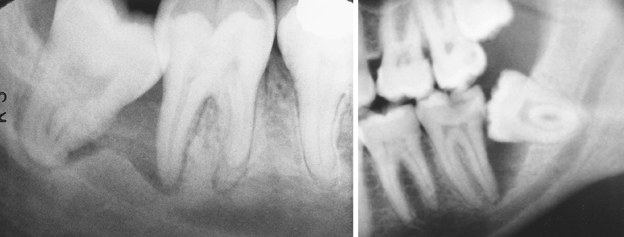 Fig. 10.2, Radiographs showing variations of a mandibular third molar impacted against a second molar with severe bone loss resulting from periodontal disease and a third molar.