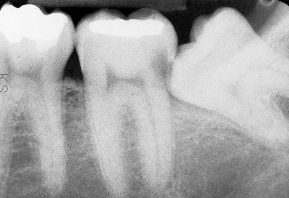 Fig. 10.3, Radiograph of caries in a mandibular second molar resulting from the presence of an impacted third molar.