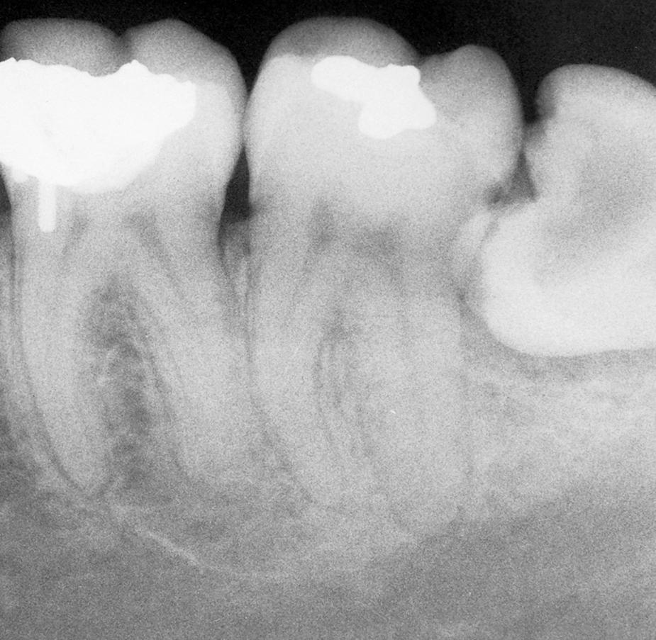 Fig. 10.4, Radiograph of caries in a mandibular impacted molar.