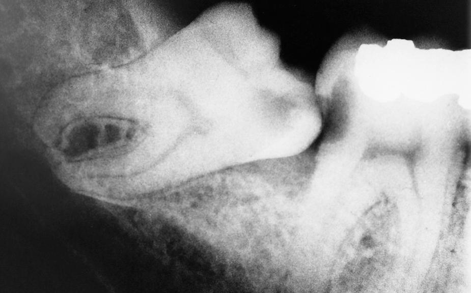 Fig. 10.5, Radiograph of caries in an impacted third molar and a second molar.