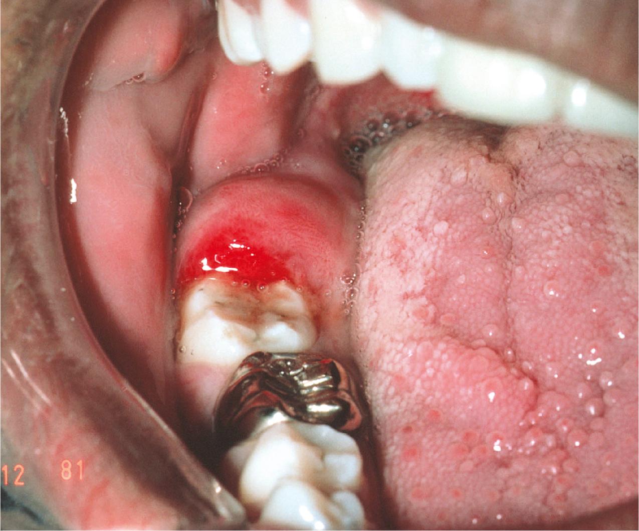 Fig. 10.6, Pericoronitis in the area of impacted tooth #32 exhibiting classic signs of inflammation with erythema and swelling. If opposing tooth #1 is erupted, it commonly impinges on this area of swelling when teeth are brought into occlusion, causing even more pain and swelling.