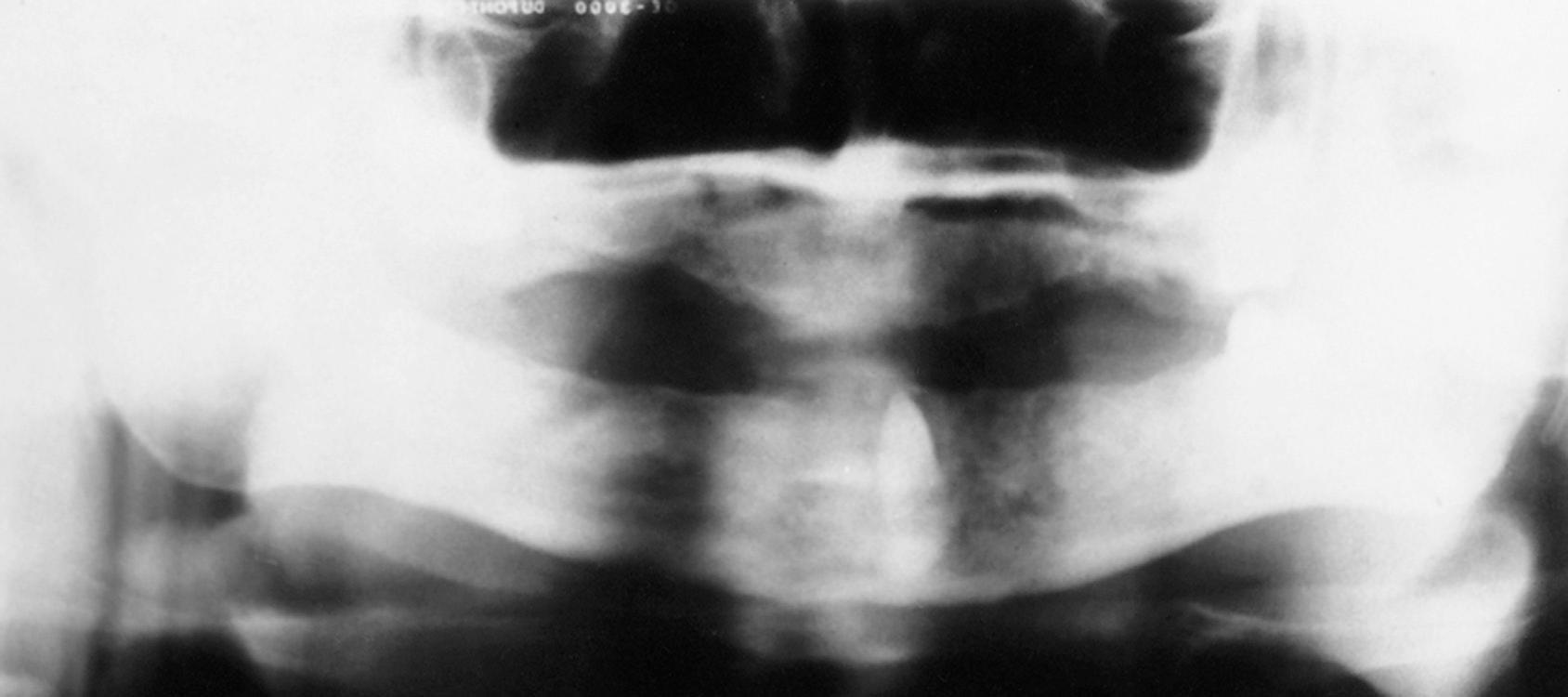 Fig. 10.8, Impacted canine retained under a denture. The tooth is now at the surface and is causing infection.